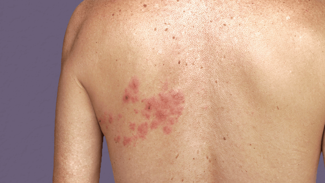 Shingles rash on back
